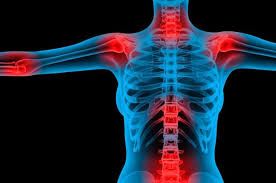 A fibromialgia afeta nervos e músculos, causando dores constantes - (Foto: Fotolia)